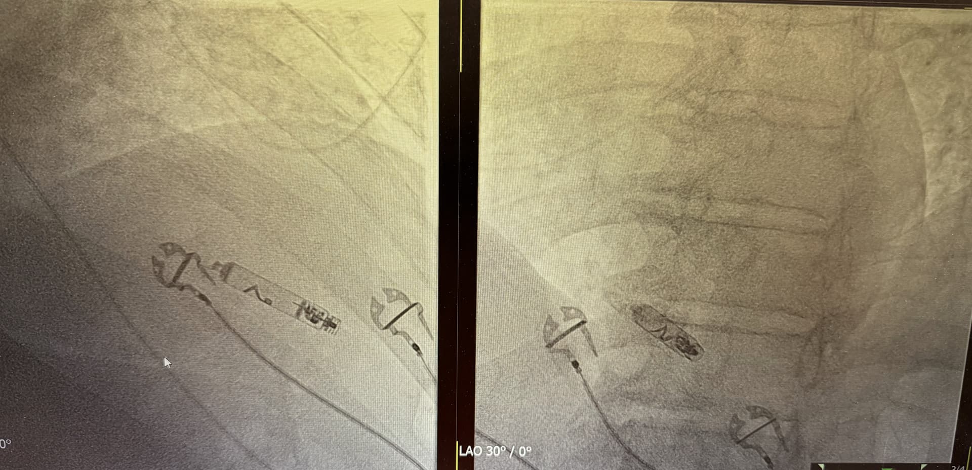 X-ray showing a leadless pacemaker implanted in the heart